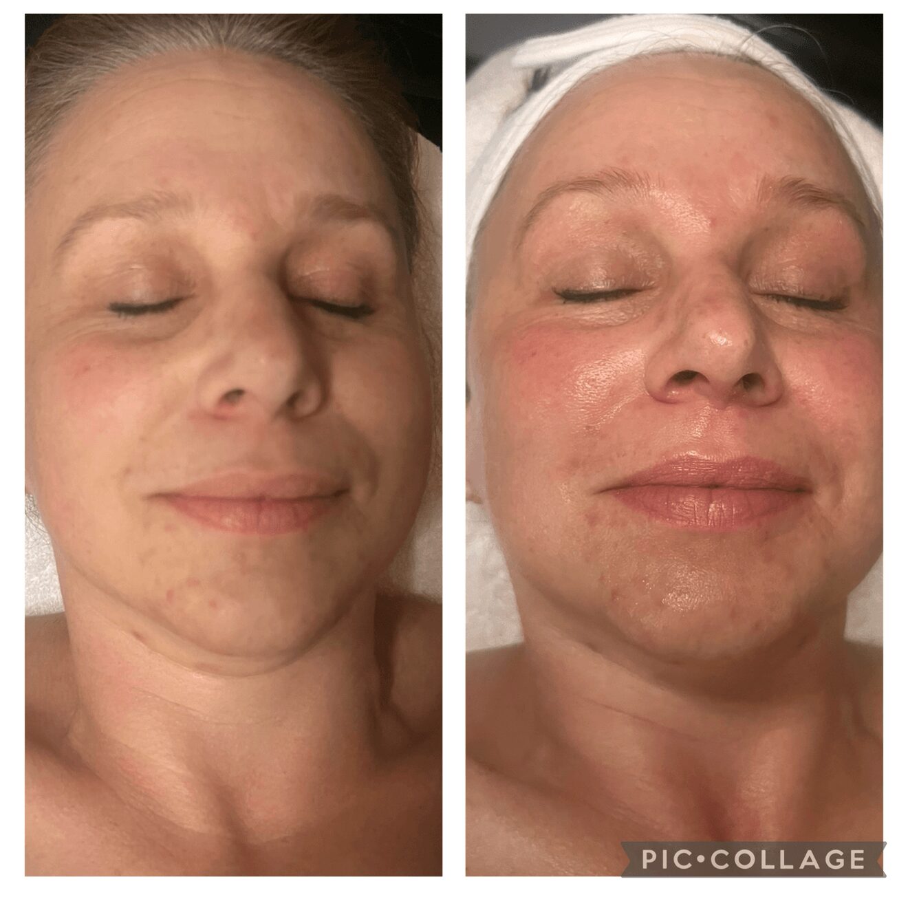 Side-by-side images of a woman with closed eyes, showing skin improvement and relaxation, before and after skincare treatment.