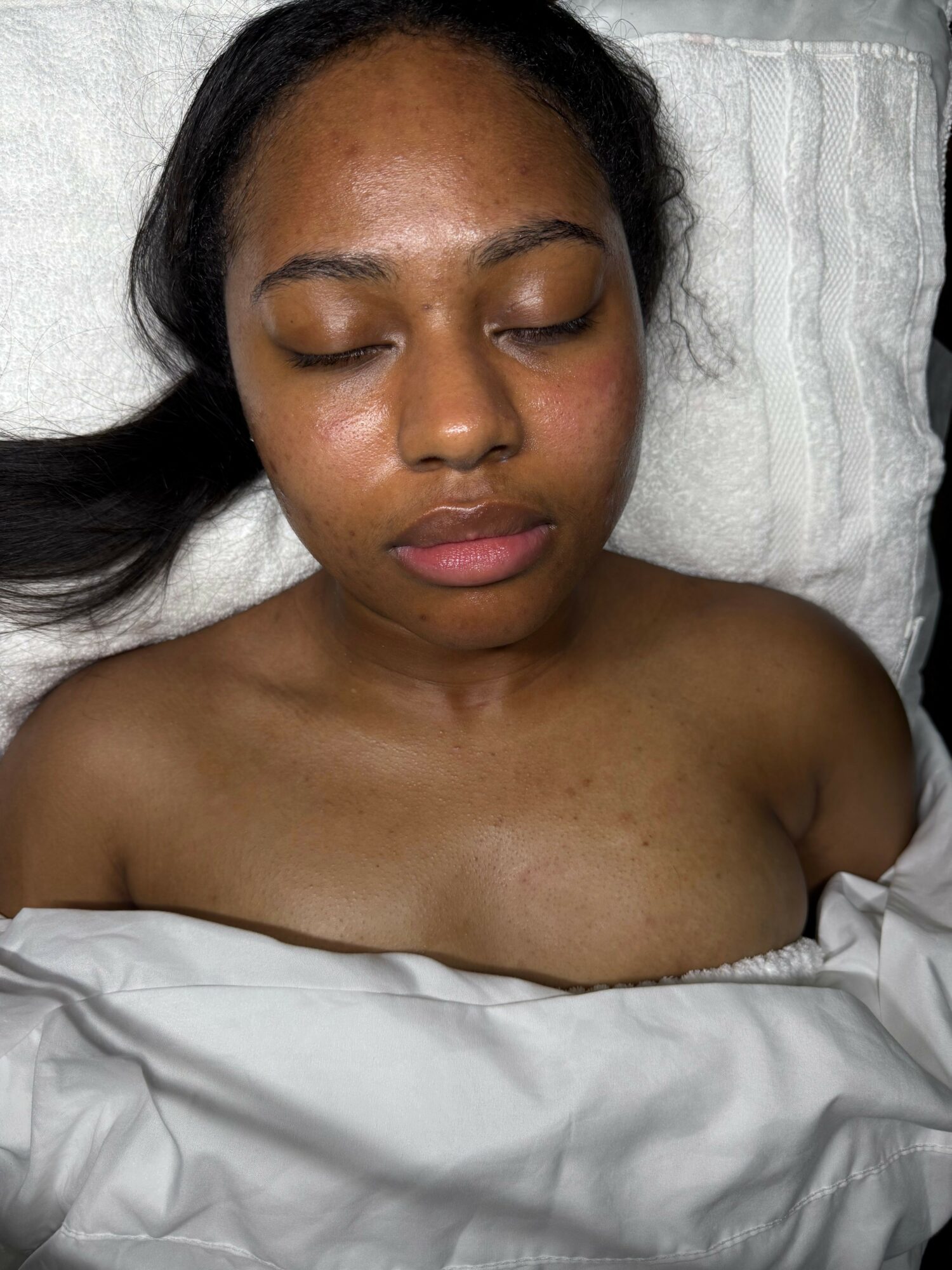 Young woman with closed eyes lying on a pillow, upper body exposed, with a white sheet covering her chest.