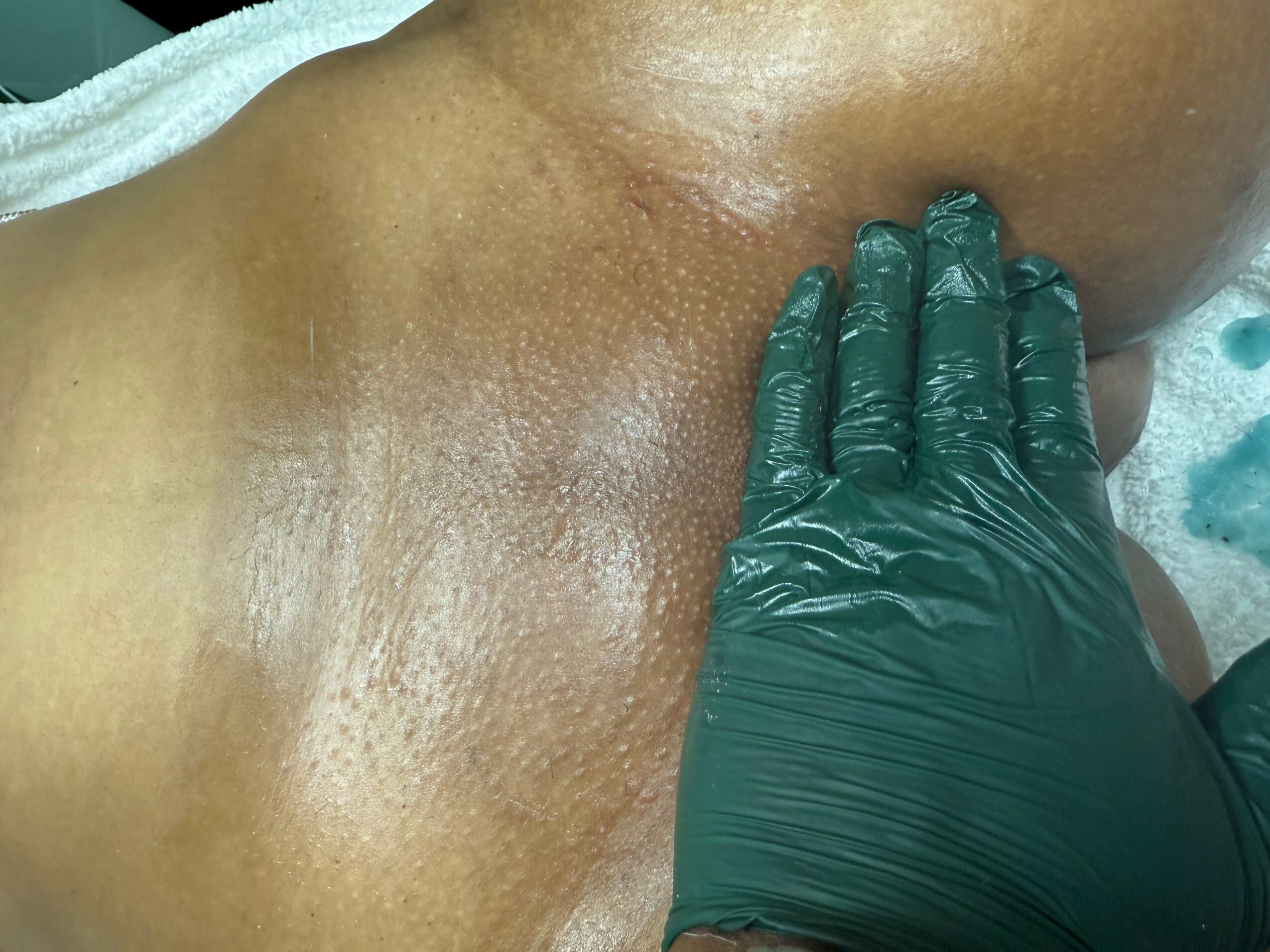 Close-up of a person's armpit with a gloved hand pressing on the skin.