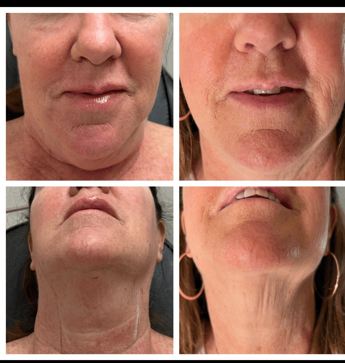 Comparison of two women’s faces and necks before and after treatment, showing skin improvements and changes in facial appearance.