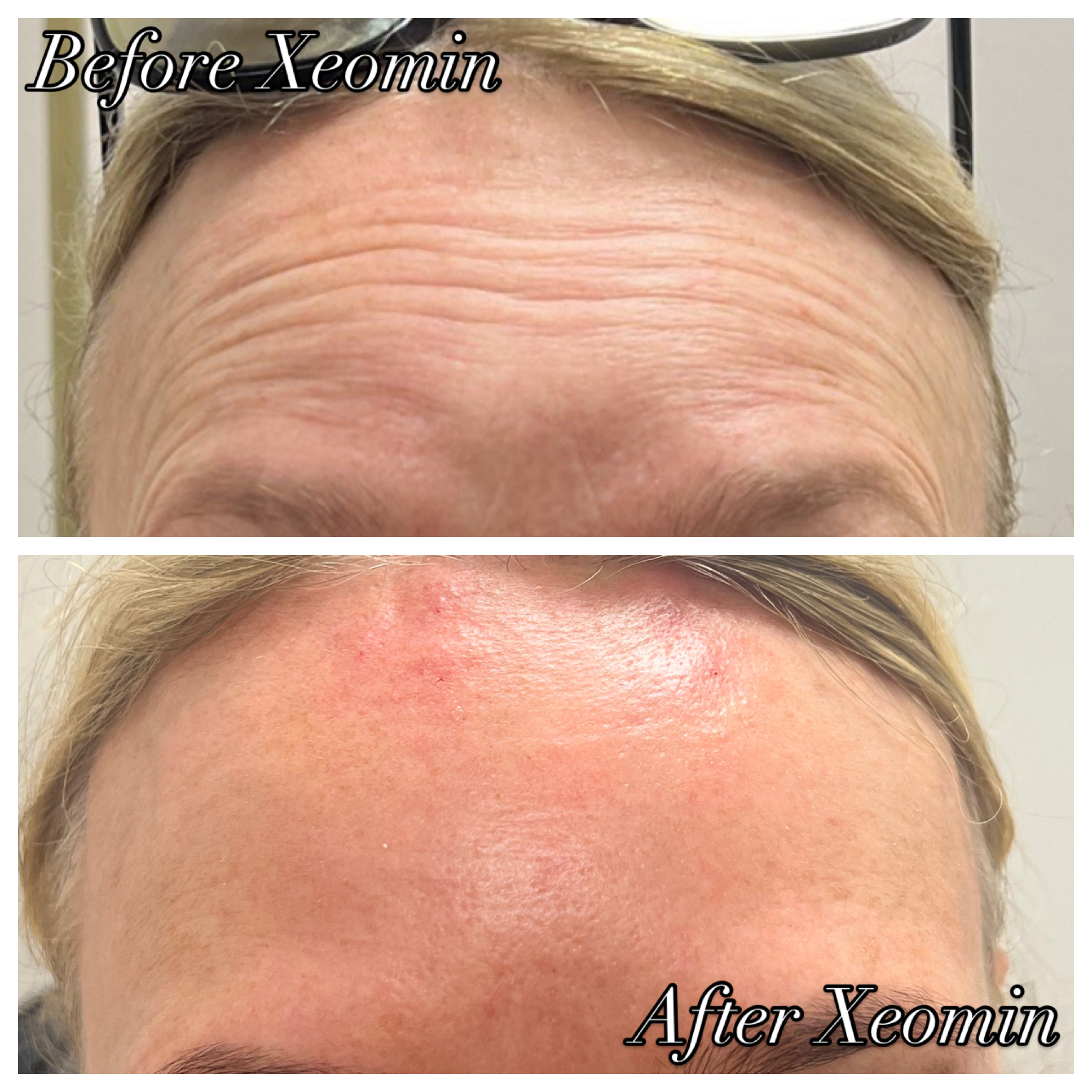 Comparison of forehead before and after Xeomin treatment showing reduced wrinkles and smoother skin.