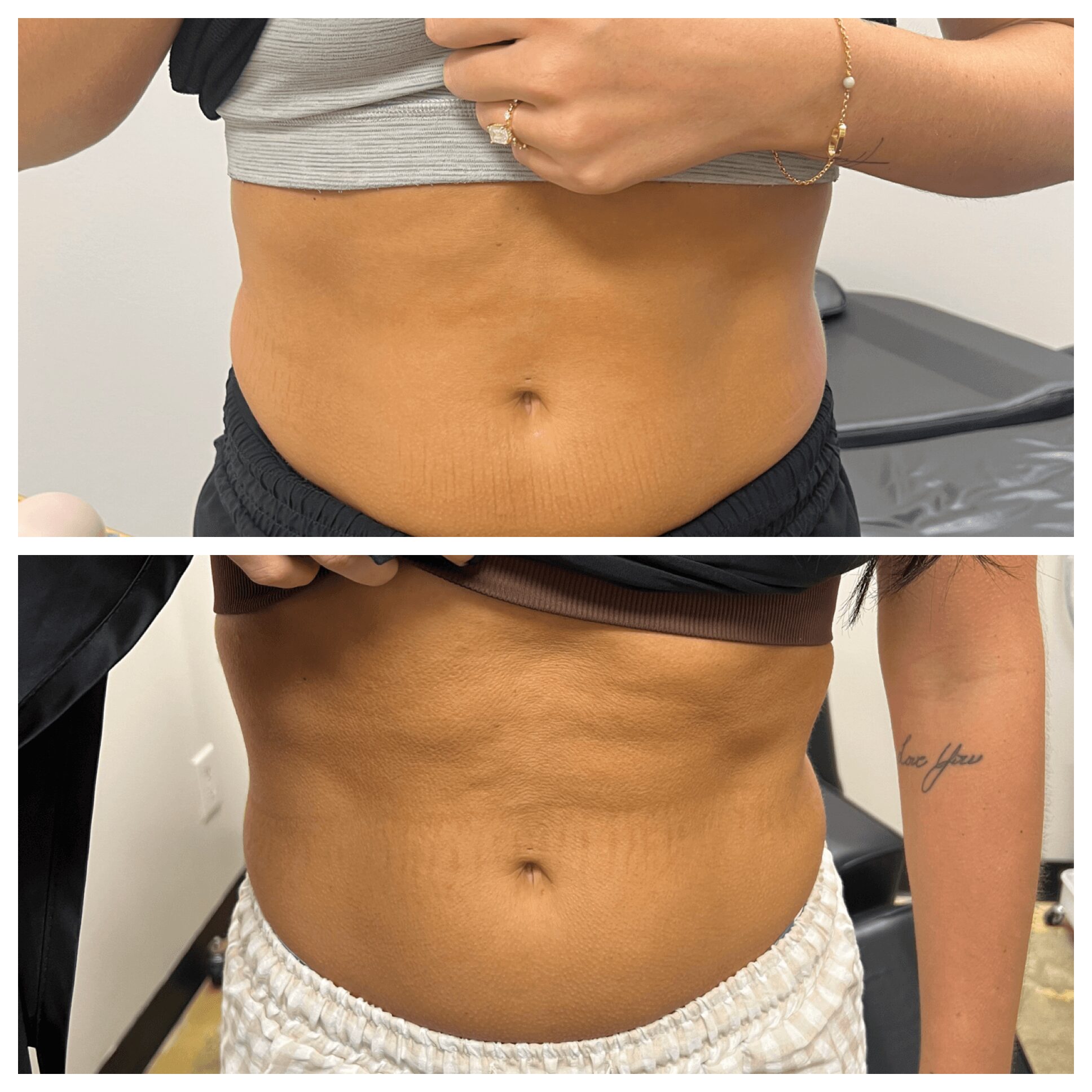 Close-up of a person's abdomen before and after a procedure, showing skin and belly button, with minimal clothing, in two images.