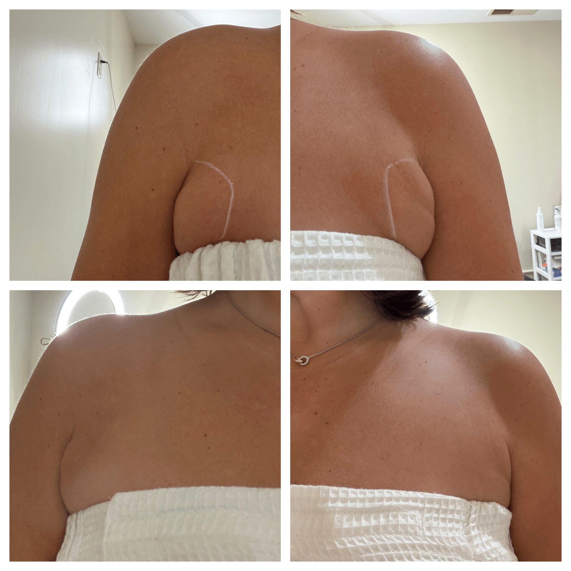Comparison of shoulder and upper chest before and after treatment, showing reduced skin sagging and improved skin appearance.