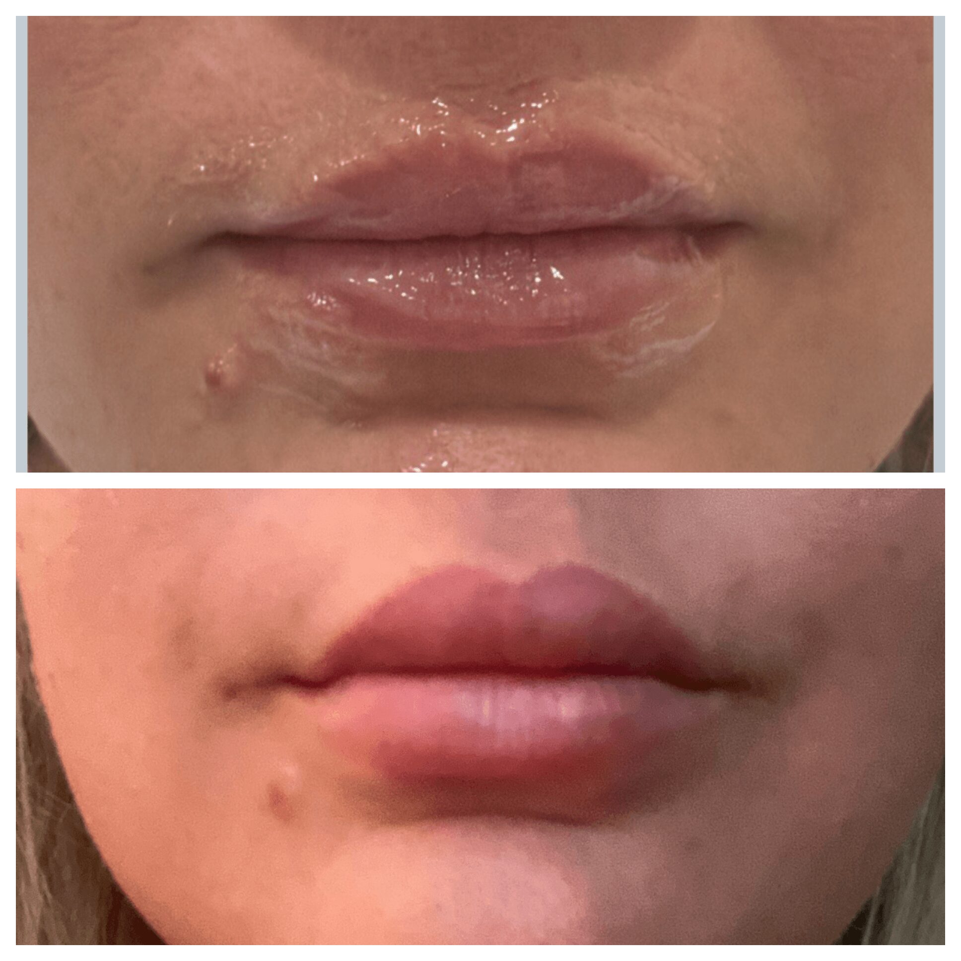 Close-up of lips before and after treatment, showing improvement in skin condition and lip fullness.