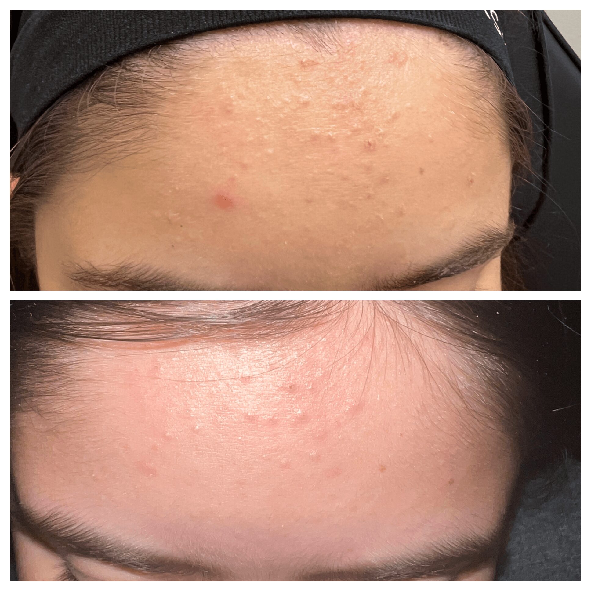 Close-up of foreheads showing skin with acne and redness, before and after treatment, with visible skin improvements.
