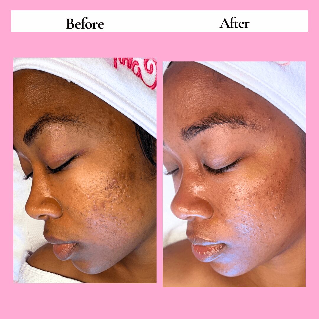 Side-by-side comparison of a woman's face showing skin improvement after treatment, with clear skin in the after image, on a pink background.