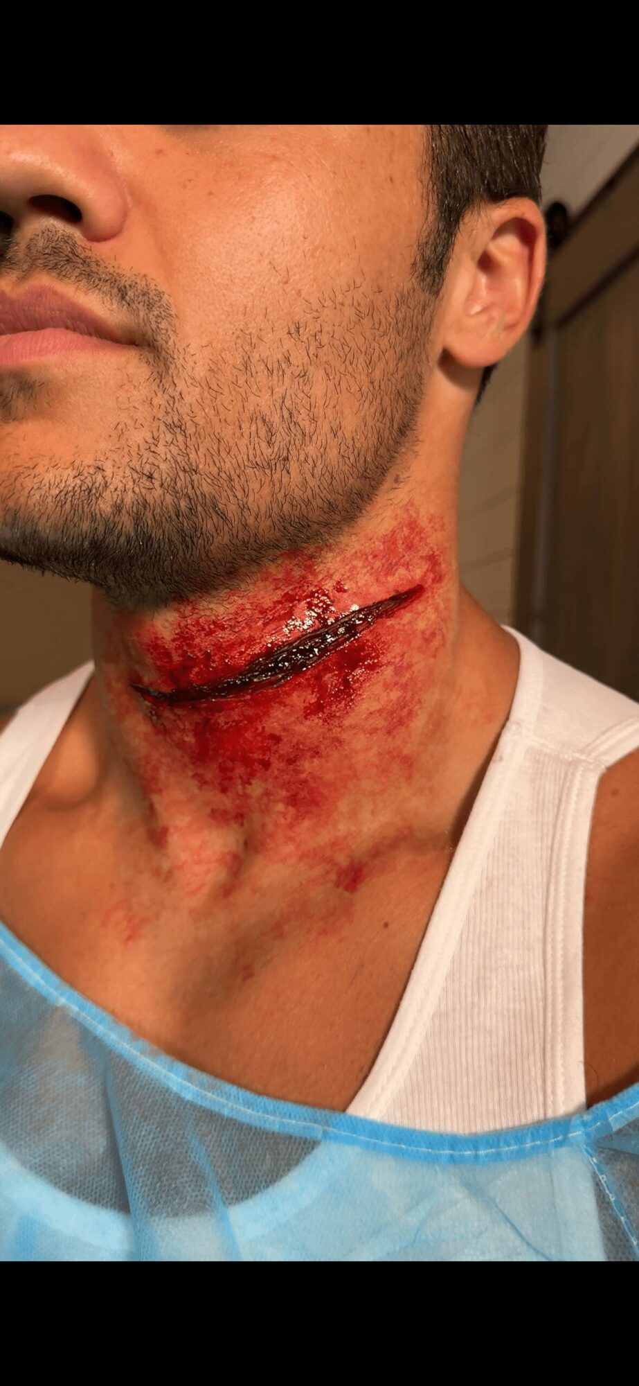 Person with a large, open wound on the neck, showing redness and injury, wearing a white tank top.