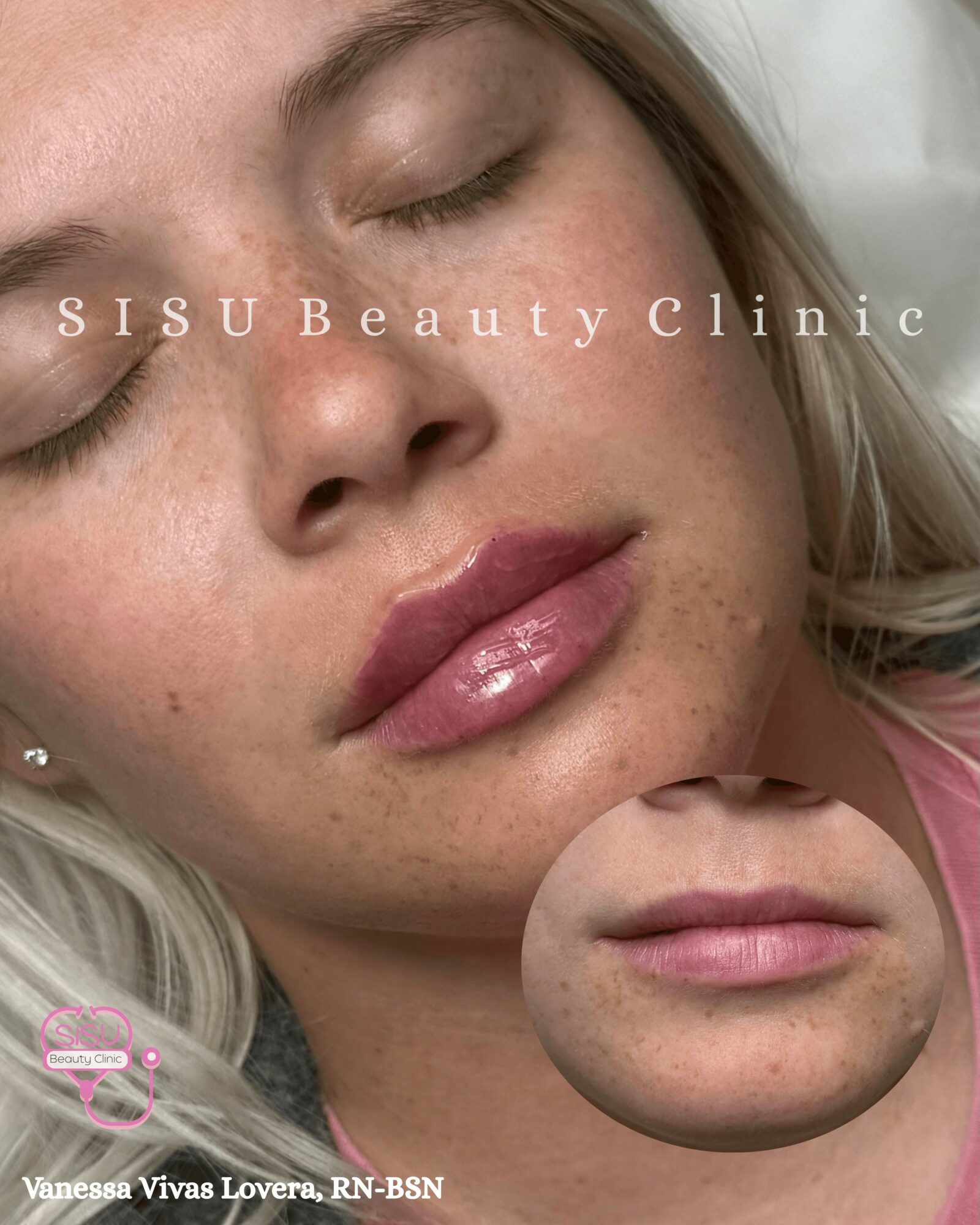 Close-up of a woman's face with closed eyes and full lips, with a smaller inset showing her lips before treatment.