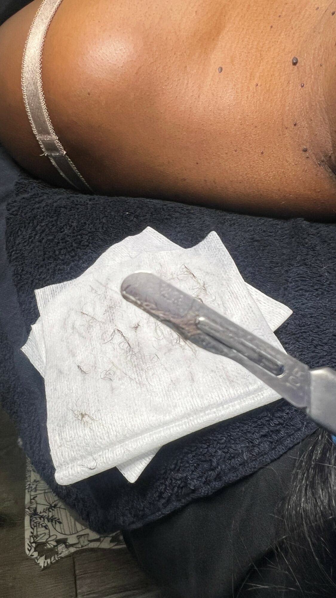 Close-up of a person's thigh with a small incision, a scalpel, and gauze pad nearby.