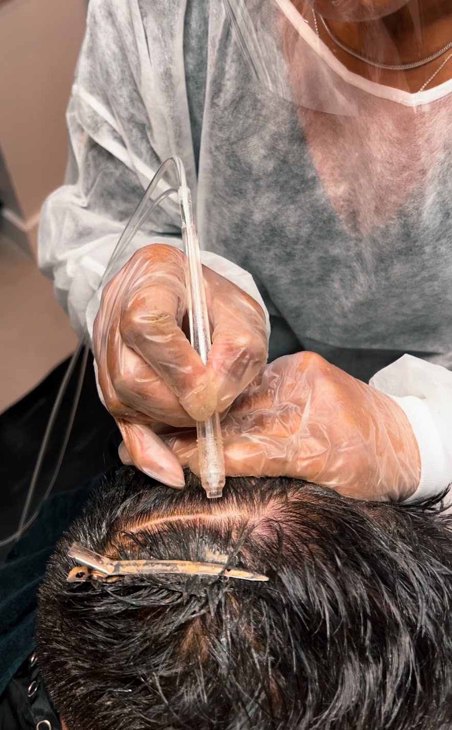 Medical professional in protective gear performs a procedure on a person's scalp with tools and gloves.