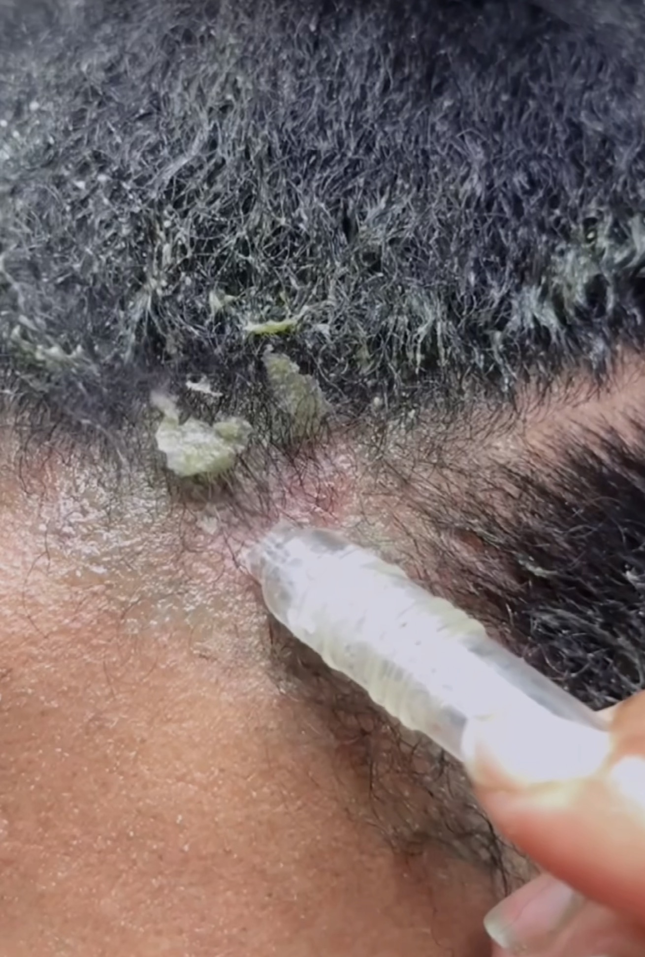 Close-up of a person applying medication or treatment to the scalp near the hairline, with visible hair and skin.