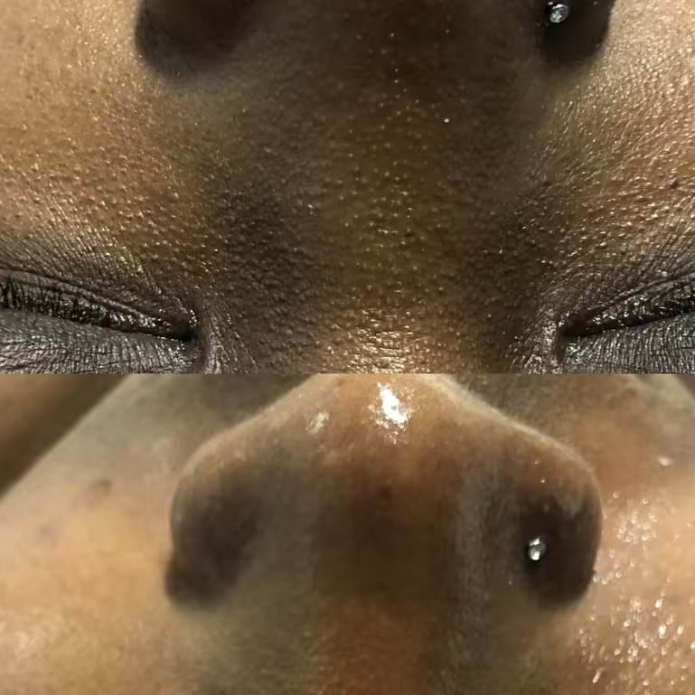 Close-up of a person's nose with visible skin texture and nostrils, viewed from below, with eyes closed.