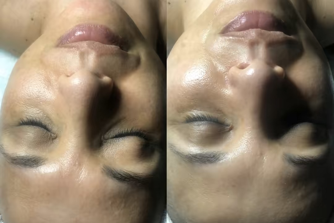 Close-up of a person's face before and after skincare treatment, showing improved skin texture and clarity.
